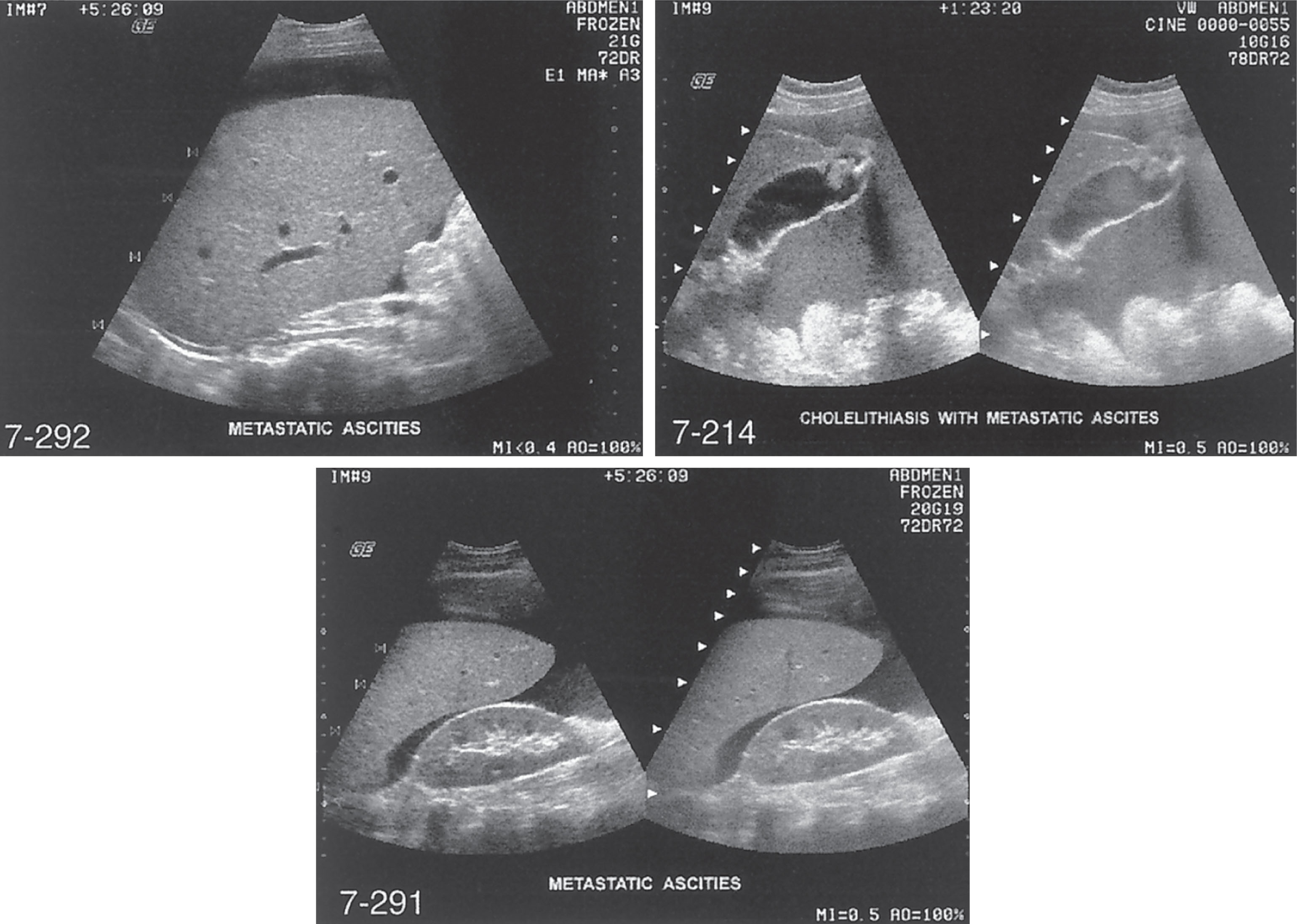 Fig. 14.19, Malignant ascites. Fine internal echoes are seen within the ascitic fluid.