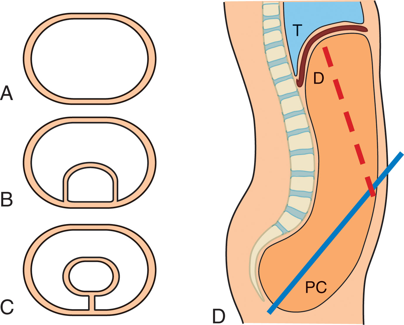 Fig. 14.2, (A) The “abdominal cavity” containing a “balloon” (peritoneum). (B) An organ inside the abdomen and partly covered by peritoneum, such as the kidney, which is said to be in the retroperitoneal cavity. (C) An organ suspended from the abdominal wall by a fold of peritoneum, such as the small intestine suspended by its mesentery. (D) When supine, the backward tilt of the pelvis makes it the lowest part of the peritoneal cavity. D , Diaphragm; dashed line , long axis of abdomen; PC , pelvic part of peritoneal cavity; solid line , long axis of pelvis; T , thorax.