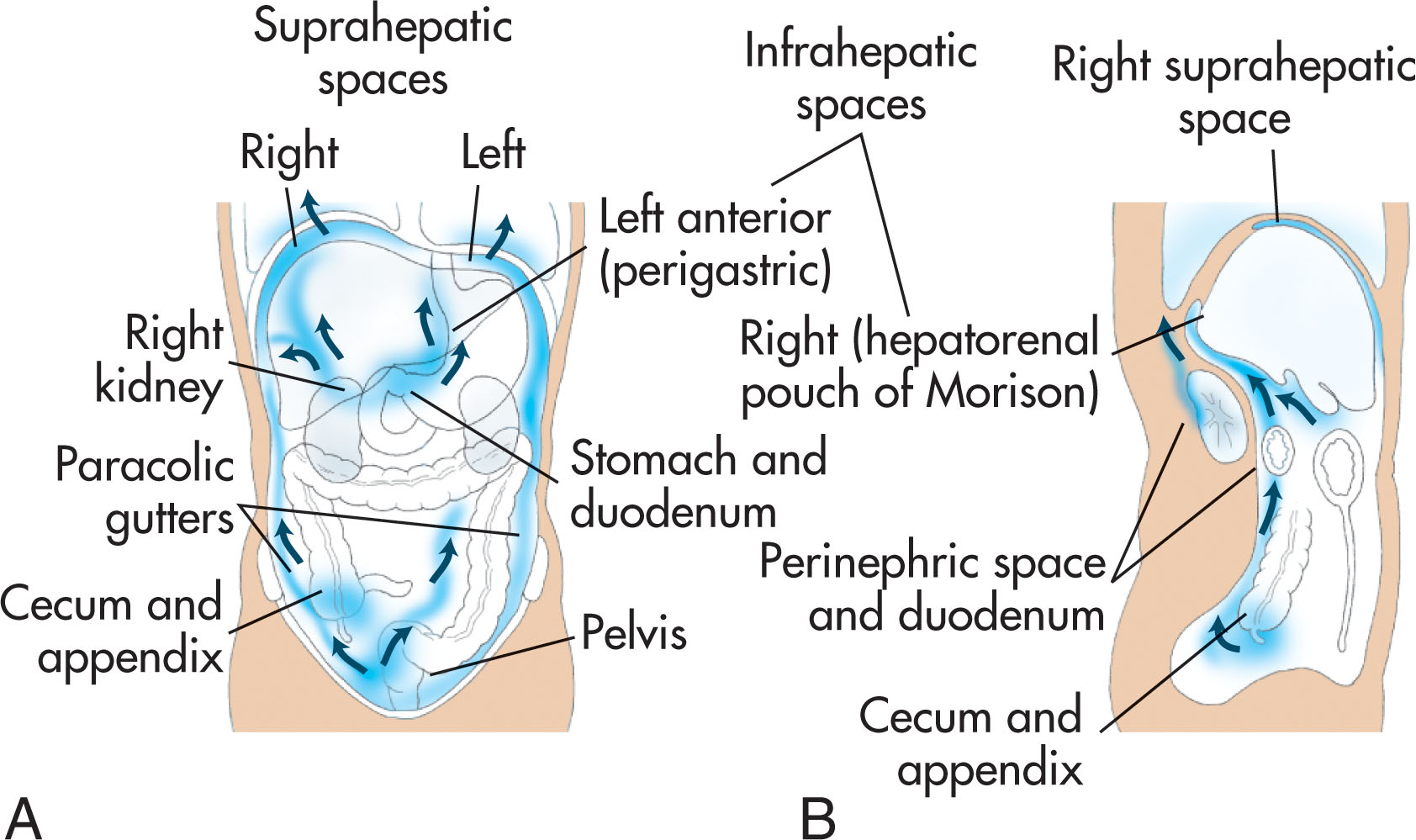 Fig. 14.5, (A) Anterior view of the collection of fluid in the abdominal and pelvic cavities. (B) Sagittal view of the right abdomen shows how the fluid collects in the most dependent areas of the abdomen and pelvis.