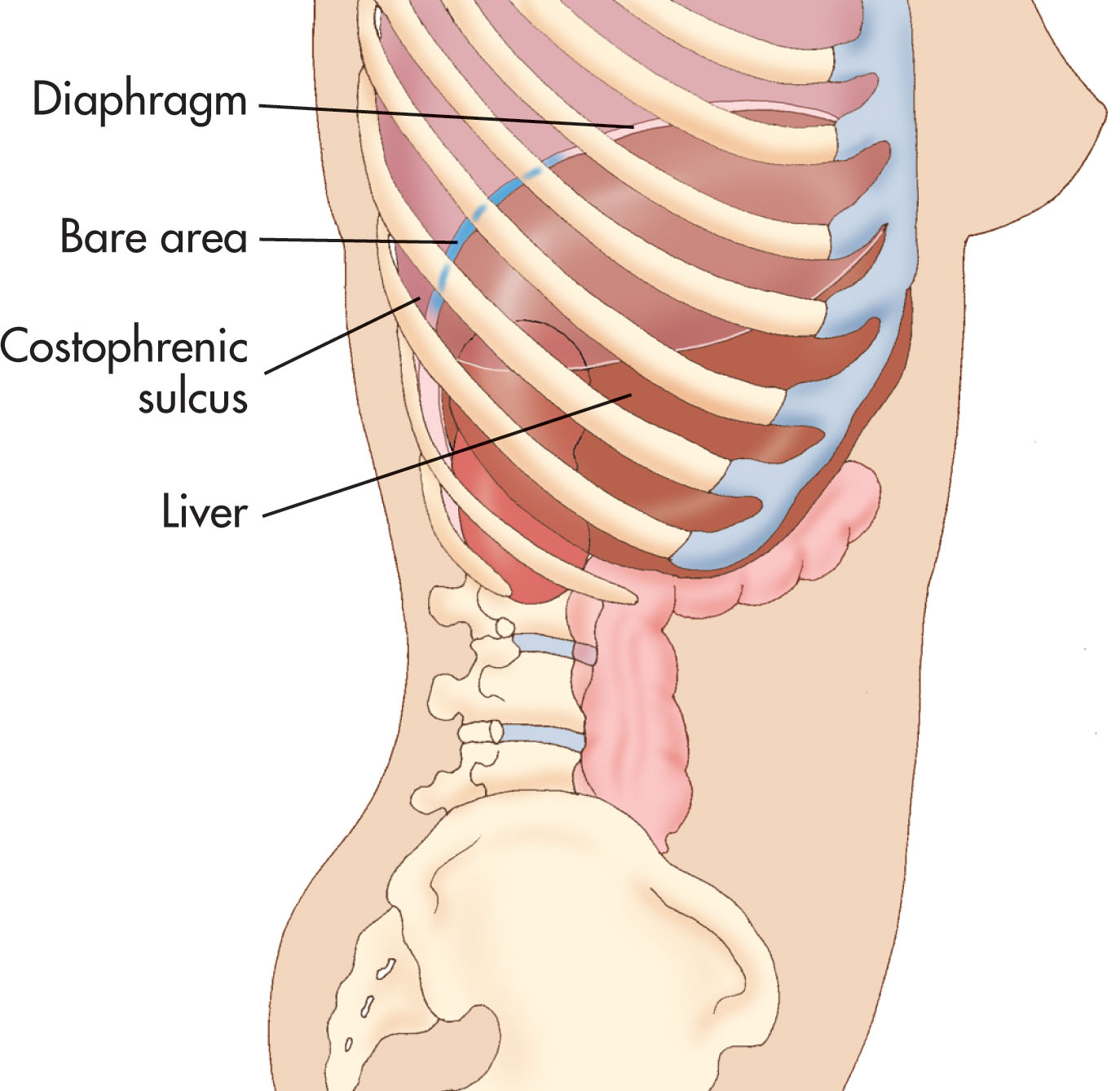 Fig. 14.8, Sagittal plane of the body shows the diaphragm and liver with the highlighted “bare” area of the liver. The costophrenic sulcus forms the sharp border posterior to the liver and may be identified when fluid is present.