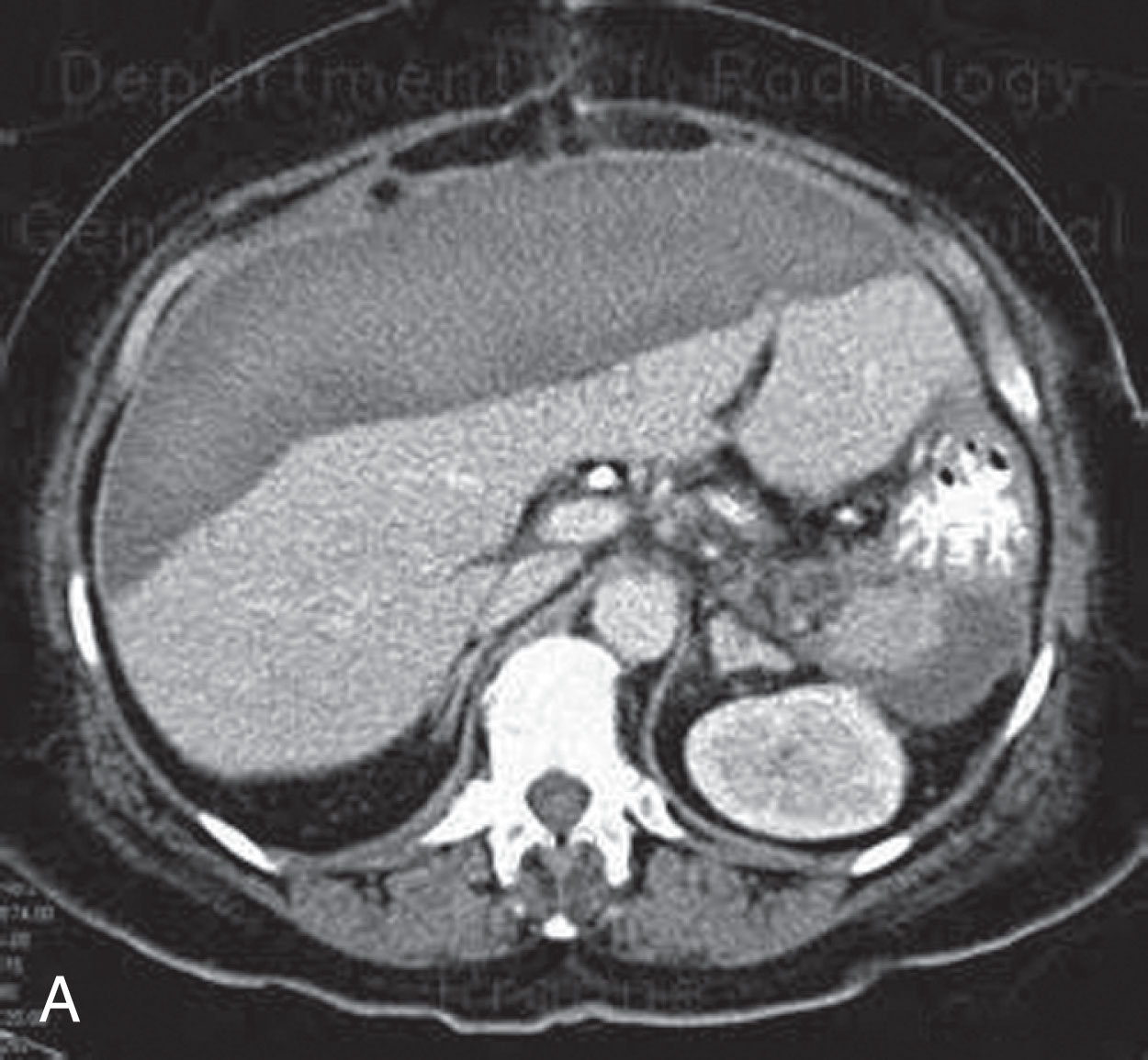 Fig. 14.10, (A) Computed tomographic image of a patient with a large subcapsular hematoma. (B) Ultrasound image of the subcapsular hematoma (arrows) .