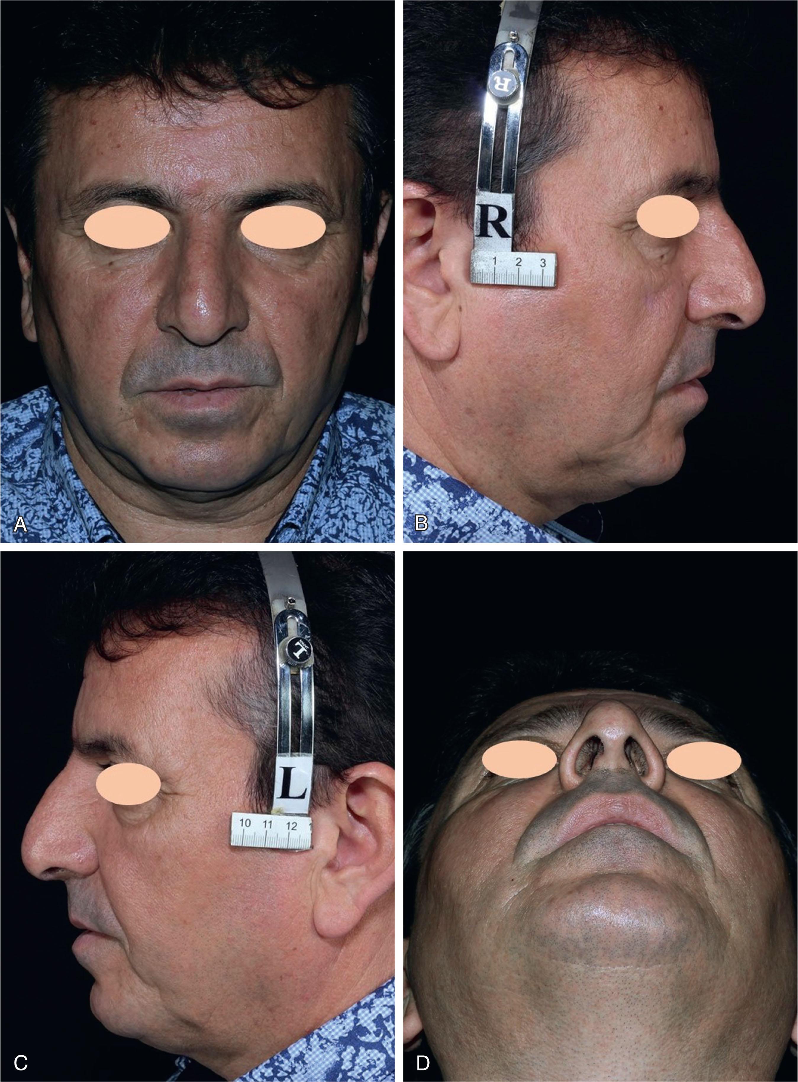 Fig. 60.2, Preoperative views of typical Persian nose. High projected dorsum, droopy tip, and thick skin are evident. (A) Front view, (B and C) side views, (D) basal view.