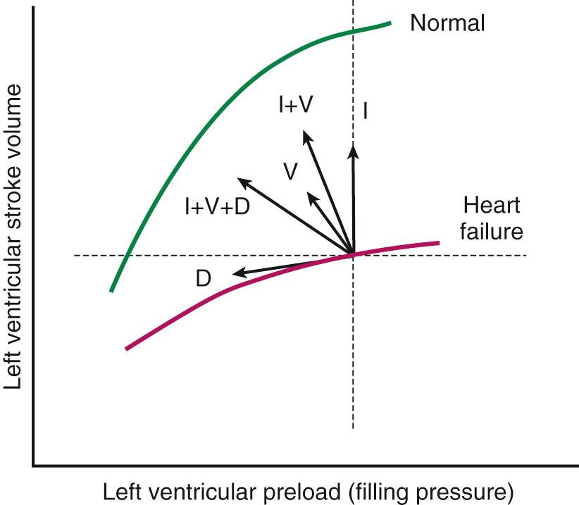 FIGURE 58-1, Frank-Starling curve with normal systolic function and with heart failure and the hemodynamic effect of pharmacologic therapy. In the normal setting, an increase in preload results in an increase in stroke volume. In heart failure, this relationship is blunted, and at any given stroke volume, the preload must be higher (horizontal dotted line) . Similarly, for any given preload, the stroke volume is lower (vertical dotted line) . Diuretic therapy (D) reduces preload without a significant effect on stroke volume, whereas inotropic therapy (I) augments stroke volume without an appreciable effect on preload. Vasodilator therapy (V) has moderate beneficial effects on both preload and stroke volume; however, the greatest effects are seen with combination therapy (I + V, I + V + D).