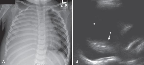 Figure 60.1, Simple effusion in a 2-year-old boy.