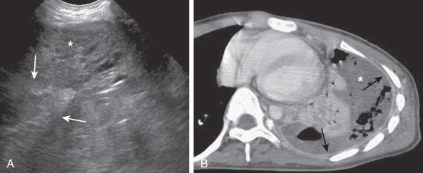 Figure 60.4, Complex effusion in a 6-year-old patient with bacterial pneumonia.