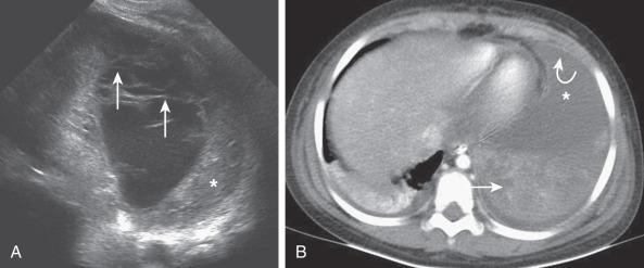 e-Figure 60.3, Complex septated effusion in a 6-year-old patient with bacterial pneumonia.