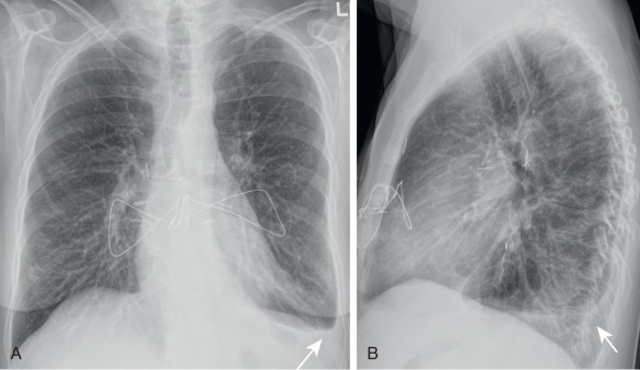 FIGURE 7.1, Meniscus sign. Posteroanterior (A) and lateral (B) chest radiographs show a small meniscus (arrows) in the left costophrenic angle in this woman after clamshell sternotomy and double-lung transplantation, representing a small left pleural effusion.