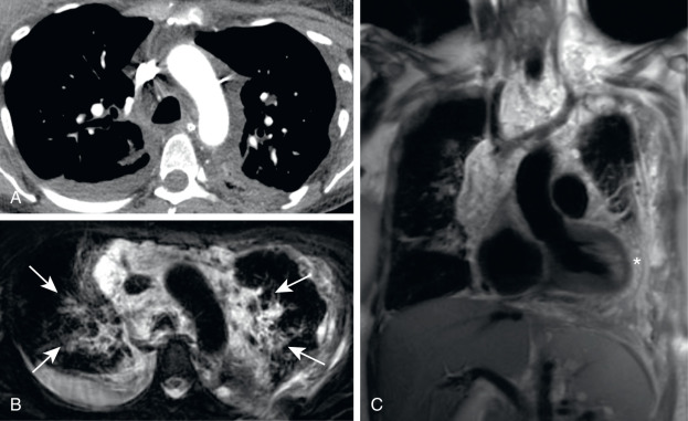 FIGURE 7.11, Chylothorax in the setting of lymphangiomatosis. A, Axial computed tomography (CT) scan shows low attenuation material in the mediastinum; tracking around and insinuating between the great vessels, trachea, and esophagus and essentially replacing all mediastinal fat. There is a small layering right pleural effusion. Indeterminate dependent material in the left posterior pleural–extrapleural space tracks partially around the left hemithorax. Axial (B) and coronal (C) fat-saturated T2-weighted magnetic resonance images acquired 2 weeks after the CT, revealing the indeterminate material throughout the mediastinum and left posterior pleural–extrapleural space to have increased over the short interval and to be composed of innumerable T2-hyperintense locules of fluid or cystic spaces, findings compatible with lymphangiomatosis. Note direct involvement of the peribronchovascular interstitium bilaterally (arrows) and direct involvement of the pericardial space (asterisk) through a defect created during remote resection of a mediastinal lymphangioma during childhood.