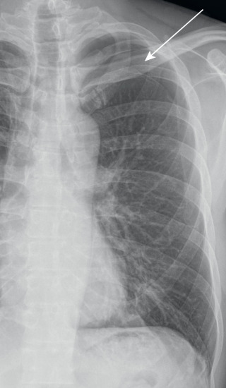 FIGURE 7.12, Pneumothorax. Posteroanterior chest radiograph reveals left apical lucency, through which no vessels pass, above a visceral pleural line (arrow) , representing a small left apical pneumothorax.