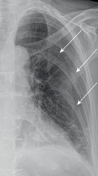 FIGURE 7.13, Skin folds. Anteroposterior supine portable chest radiograph reveals two adjacent skin folds (arrows) overlying the left hemithorax. Note the increasing attenuation, from medial to lateral, until the acute drop-off in attenuation at the edge of the skin fold, in contrast to the lucency found on either side of a pneumothorax (pulmonary parenchymal lucency on one side and interpleural lucency on the other). There has been a median sternotomy and coronary artery bypass graft with left internal mammary artery graft placement (the latter demarcated by surgical clips along the left cardiac margin).