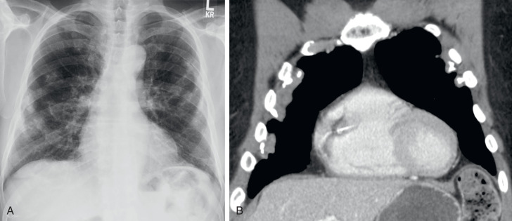 FIGURE 7.17, Asbestos-related pleural plaques. A, Posteroanterior chest radiograph reveals multiple bilateral calcified pleural plaques, many of which are en face. Some of these en face plaques resemble a holly leaf. B, Correlative coronal computed tomography scan showing multiple bilateral, partially calcified pleural plaques.