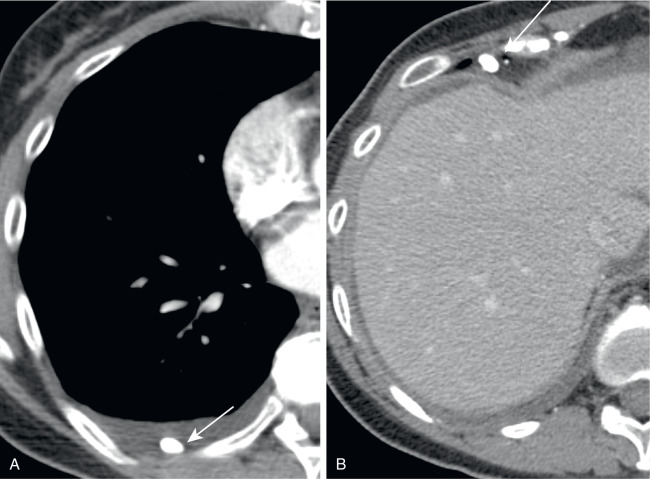 FIGURE 7.18, Thoracolith. A, Axial chest computed tomography (CT) scan revealing a small, ovoid, calcified nodule (arrow) located dependently within a small, layering right pleural effusion. B, Axial chest CT performed 3 weeks later showing interval movement of this thoracolith, now lodged in the right anterior costophrenic angle (arrow) , proving it to be a thoracolith, as opposed to a fixed, calcified parietal pleural nodule or plaque.