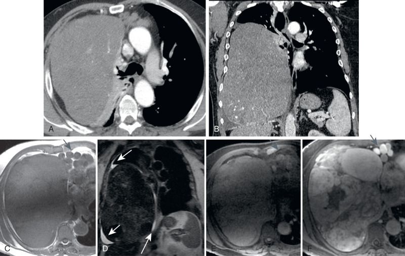 FIGURE 7.19, Solitary fibrous tumor (SFT), benign appearance. A, Axial computed tomography (CT) scan showing a large, well-circumscribed mass of slightly heterogeneous attenuation filling much of the right hemithoracic cavity, with extrapleural fat laterally and anteriorly and with compressive and relaxation atelectasis medially. There is leftward cardiomediastinal shift. B, Coronal CT scan shows this mass to depress and flatten the right hemidiaphragm. Axial T1-weighted (C) , coronal T2-weighted ( D ), and axial pre- (E) and postcontrast T1-weighted (F) magnetic resonance images reveal the mass to be of intermediate T1 signal and marked T2 hypointensity, with a partially circumferential T2-hyperintense pleural effusion (white arrows) . The mass enhances heterogeneously, along with the enhancing right pericardiophrenic varices (gray arrow) that have arisen as a result of venous compression by the mass. The marked T2 hypointensity of this mass, in conjunction with its solitary nature and location in the pleural space, confers a diagnosis of SFT of the pleura and excludes sarcoma, lymphoma, and a large lung cancer. These latter diagnoses would be T2-hyperintense on magnetic resonance imaging.