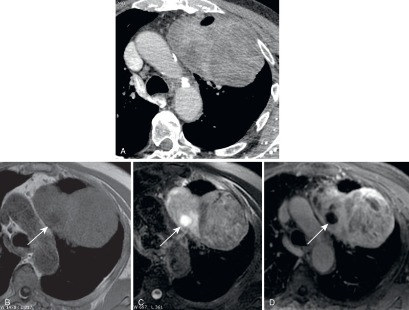 FIGURE 7.20, Solitary fibrous tumor of the pleura (SFTP), malignant appearance. A, Axial chest computed tomography (CT) scan with intravenous contrast shows a large, heterogeneously enhancing mass filling the anterior aspect of the left hemithoracic cavity with possible chest wall invasion. The intrathoracic compartment from which this mass arises is unclear by CT. The air pocket anteriorly represents normal aerated lung on the lung window (latter not shown). Axial T1-weighted (B) , axial T2-weighted (C) , and postcontrast fat-saturated axial T1-weighted (D) MR images reveal the mass to be very well circumscribed and pedunculated, displacing the anterior mediastinal fat pad to the right; it therefore likely arises from the pleural space. The mass is of heterogeneous but primarily intermediately-to-mildly hyperintense T1 signal and heterogeneous, primarily hyperintense T2 signal; it demonstrates heterogeneous and fairly intense enhancement. This MRI reveals no chest wall invasion. The nonenhancing, focal round area of T1-hypointense, T2-hyperintense signal (arrow) represents cystic change. There are scattered areas of focal, patchy low T2 signal within the mass representing fibrous tissue, sometimes referred to as the “chocolate chip cookie sign” of SFTs. The predominance of T2 hyperintensity, vigorous enhancement, and cystic change favor a malignant SFT over a benign SFT. The fibrous areas within the tumor favor SFT over a sarcoma.