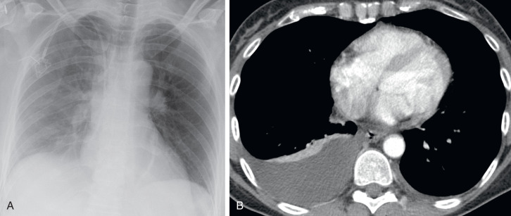 FIGURE 7.2, Freely layering right pleural effusion in a supine patient. A, Anteroposterior supine portable radiograph reveals graduated hazy attenuation from right apex to base caused by a small-to-moderate, layering right pleural effusion. An infusion port catheter terminates in the upper right atrium. B, Chest computed tomography (CT) scan with intravenous contrast shows the correlative water attenuation, layering right pleural effusion, with associated homogeneously enhancing and somewhat crescentic, mild right lower lobe relaxation atelectasis.