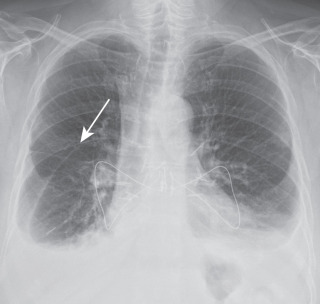 FIGURE 7.3, Bilateral pleural effusions with right major fissural extension (arrow) . Posteroanterior radiograph reveals small to moderate bilateral pleural effusions, right of which extends into and outlines the right major fissure in this woman status post clamshell sternotomy and double-lung transplantation.