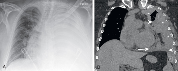 FIGURE 7.4, Extensive unilateral pleural disease with contralateral mediastinal shift in man with metastatic renal cell carcinoma. Posteroanterior chest radiograph (A) and corresponding coronal computed tomography (CT) scan (B) show near-complete left hemithoracic opacification with rightward cardiomediastinal shift, revealed by CT to be secondary to diffuse, nearly circumferential pleural thickening (asterisks) , pleural fluid (arrows) , and atelectasis (lung volume loss).