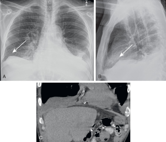 FIGURE 7.5, Subpulmonic pleural effusion. Posteroanterior (A) and lateral (B) chest radiographs demonstrate a right subpulmonic pleural effusion (arrows) simulating the right hemidiaphragm or creating a “pseudodiaphragm appearance” with its well-defined margin and a more lateral peak than would be expected for the right hemidiaphragm. A small left pleural effusion and bibasilar atelectatic changes are also present. C, Correlative coronal computed tomography scan without contrast showing the right subpulmonic pleural fluid and small left pleural effusion.