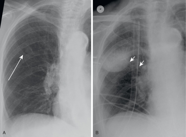 FIGURE 7.7, Pleural pseudotumor. A, Preoperative posteroanterior chest radiograph shows a small nodule in the right upper lung (long arrow) . B, Postoperative anteroposterior supine portable chest radiograph after wedge resection reveals a new oval, partially well-defined right midlung opacity at the level of the lateral aspect of the right major fissure. Its ill-defined upper border, representing an “incomplete border sign,” indicates its pleural, rather than parenchymal, location and that this finding represents loculated pleural fluid in the fissure or a pleural pseudotumor rather than a pulmonary hematoma or other mass. The surgical staple line is largely medial to this loculated pleural fluid (short arrows) . A right chest tube is present.