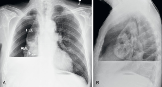 FIGURE 7.8, Hydropneumothorax. Posteroanterior (PA) (A) and lateral (B) chest radiographs show an air–fluid level (AFL) in the mid-to-lower hemithorax caused by pleural fluid interfacing with a large pneumothorax. The lung cancer–containing right lung is collapsed, with all three lobes identifiable as separate entities on the PA view. Note the discrepant length of the AFLs on the PA and lateral radiographs, another finding (besides the pneumothorax) indicative of the pleural, rather than parenchymal, location of this fluid. RLL, Right lower lobe; RML, right middle lobe; RUL, right upper lobe.