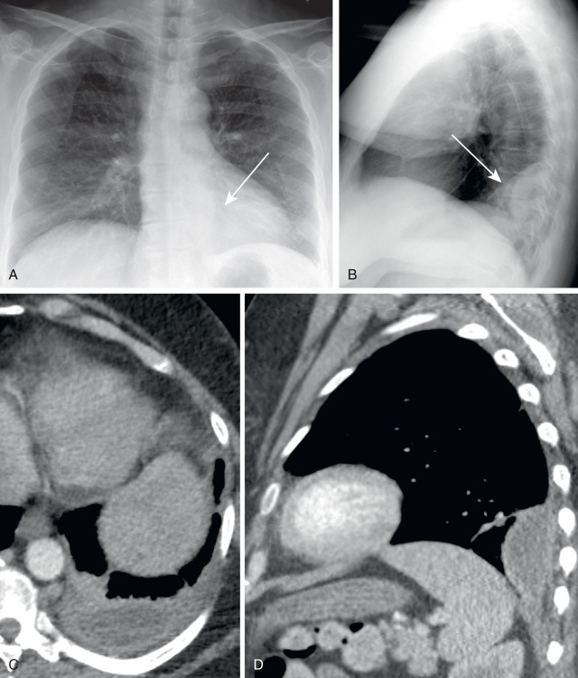 FIGURE 7.9, Empyema. Posteroanterior (A) and lateral (B) chest radiographs reveal a semilunar mass silhouetting the left paraspinal line and mimicking a left posterior mediastinal mass (arrows) . Axial (C) and sagittal (D) chest computed tomography scans with intravenous contrast reveal this radiographic finding to correspond to a loculated, lentiform left pleural effusion surrounded by thickened visceral and parietal pleura, the so-called split pleura sign of an empyema.