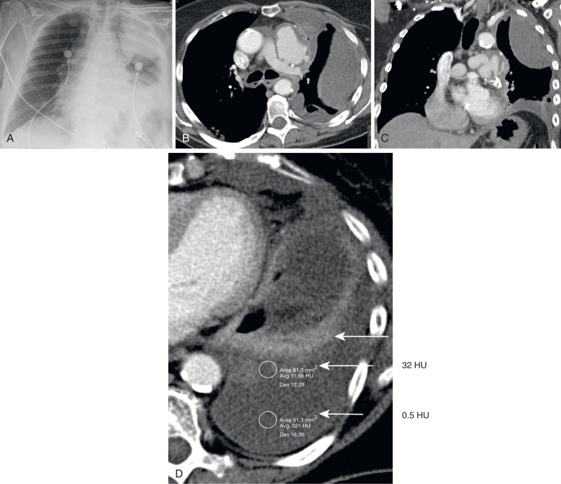 FIGURE 7.10, Hemothorax. A, Anteroposterior supine portable chest radiograph shows a multiloculated left pleural effusion or pleural masses (or both). B and C, Axial and coronal chest computed tomography (CT) scan with intravenous contrast shows correlative multiloculated pleural fluid collections. D, Axial CT more inferiorly reveals a fluid–fluid level composed of dependent, more serous hemorrhage of water attenuation—0.5 Hounsfield units (bottom arrow) and less dependent, more cellular hemorrhage measuring 32 Hounsfield units (HU) (middle arrow) , a so-called hematocrit level often characteristic of a subacute collection of blood. Homogeneously enhancing, crescentic relaxation atelectasis (top arrow) is present along the anterior aspect of this fluid.