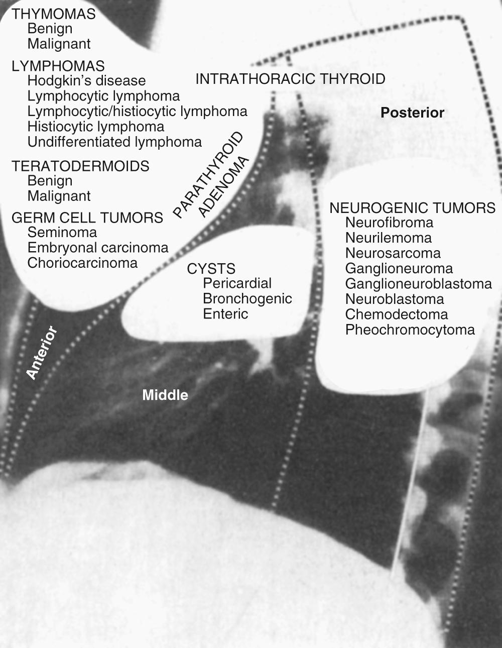 FIGURE 43-1, Lateral chest film divided into three anatomic subdivisions with the most common location of the tumors and cysts.