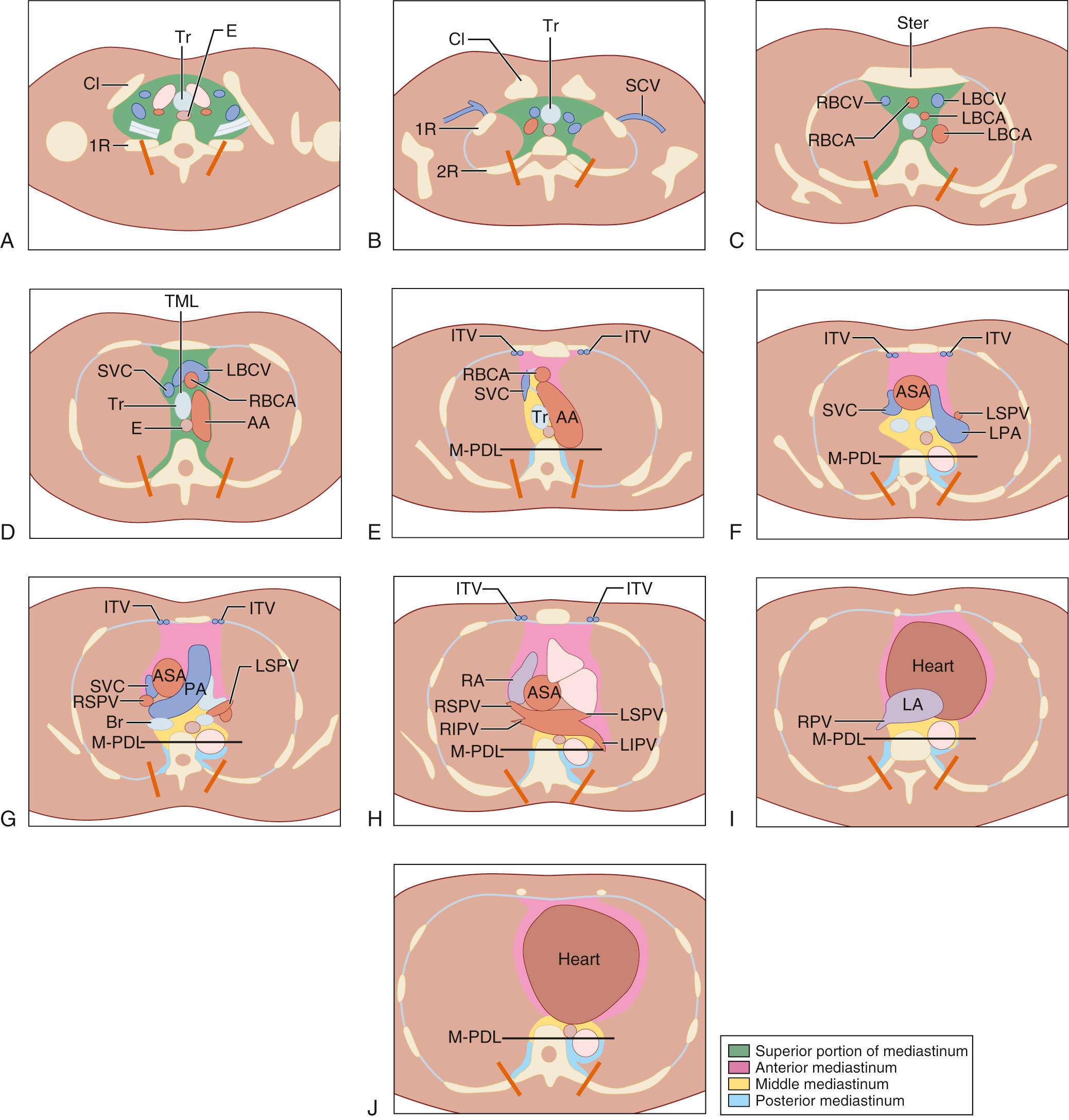 FIGURE 43-2, Mediastinal compartment classification according to the General Rules for Study of Mediastinal Tumors of the Japan Association for Research on the Thymus. A, Thoracic inlet. B, Upper rim of clavicle. C, Sternoclavicular joint. D, Left brachiocephalic vein across TML. E, Aortic arch. F, Tracheal carina. G, Right main pulmonary artery. H, Pulmonary trunk. I, Left atrium. J, Tricuspid valve. 1R, First rib; 2R, second rib; AA, aortic arch; AsA, ascending aorta; Br, bronchus; CL, clavicle; E, esophagus; ITV, internal thoracic vessels; LA, left atrium; LBCV, left brachiocephalic vein; LCCA, left common carotid artery; LIPV, left inferior pulmonary vein; LPA, left pulmonary artery; LSCA, left subclavian artery; LSPV, left superior pulmonary vein; M-PBL, middle-posterior boundary line; PA, pulmonary artery; RA, right atrium; RBCA, right brachiocephalic artery; RBCV, right brachiocephalic vein; RIPV, right inferior pulmonary vein; RSPV, right superior pulmonary vein; SCA, subclavian artery; SCV, subclavian vein; Ster, sternum; SVC, superior vena cava; TML, tracheal mid-line; Tr, trachea.