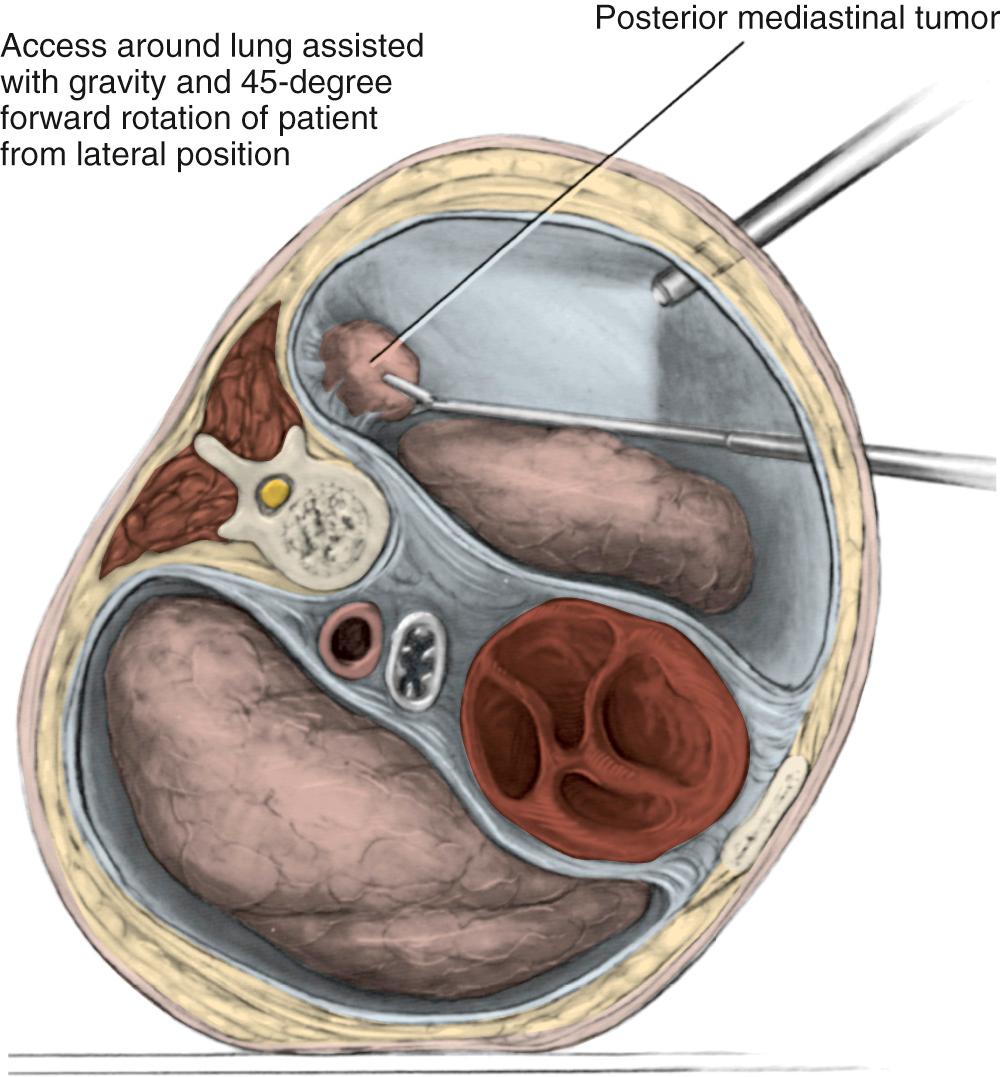 FIGURE 43-3, Thoracoscopic resection of a posterior mediastinal tumor.