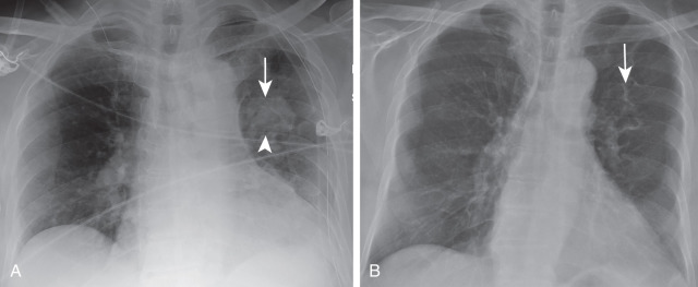 FIGURE 12.1, Images after left upper lobe wedge resection with associated parenchymal hematoma. A, Supine chest radiograph 3 days after surgery demonstrates surgical staple line (arrow) and associated parenchymal hematoma (arrowhead) . B, Posteroanterior chest radiograph 5 months later reveals complete resolution of a hematoma. Note the staple line (arrow) .