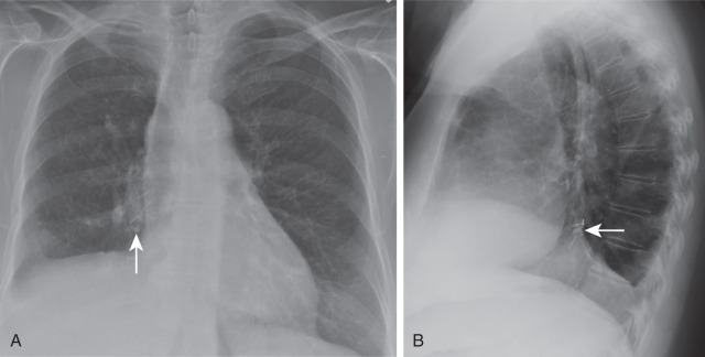 FIGURE 12.3, Images after right lower lobectomy. Posteroanterior (A) and lateral (B) chest radiographs 1 year after surgery demonstrate volume loss of the right lung, elevation of the right hemidiaphragm, and surgical clips in the right infrahilar region (arrows) .