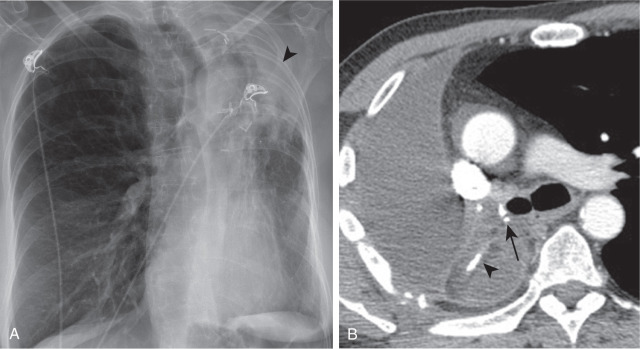 FIGURE 12.4, Intercostal muscle flap used for bronchial stump reinforcement A, Anteroposterior chest radiograph after left upper lobectomy demonstrates volume loss of the left lung and opacity in the left upper hemithorax extending from the left hilum to the chest wall (arrowhead) . B, Axial chest computed tomography scan in a different patient after right pneumonectomy reveals hilar surgical clips (arrow) and muscle flap (arrowhead) .