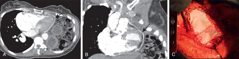 FIGURE 12.5, Images after left intrapericardial pneumonectomy and pericardial defect reconstruction Axial (A) and coronal (B) images of chest computed tomography scans 2 years after surgery demonstrate hyperdense pericardial patch (straight arrows) . C, Intraoperative image of a pericardial synthetic patch.