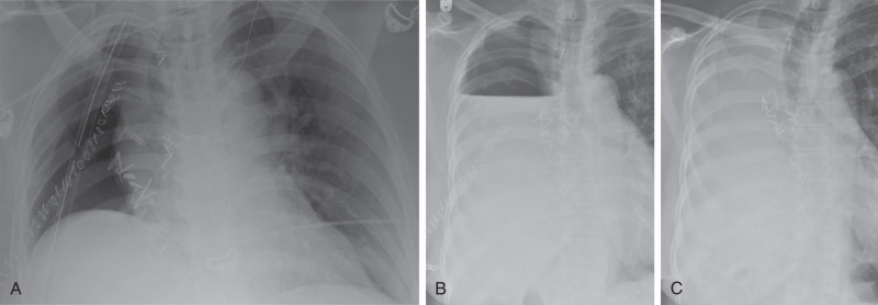 FIGURE 12.6, Post right pneumonectomy. A to C, Serial postoperative chest radiographs demonstrate gradual resorption of air and filling of right postpneumonectomy space with fluid. Note also the gradual shift of the mediastinum to the right.