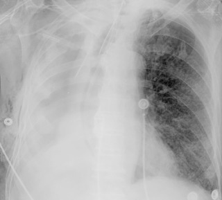 FIGURE 12.7, Postpneumonectomy pulmonary edema. Anteroposterior chest radiograph in the immediate postoperative period after right pneumonectomy demonstrates vascular indistinctness and perihilar fullness consistent with pulmonary edema in the left lung.