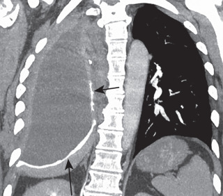 FIGURE 12.8, Post right extrapleural pneumonectomy. Coronal chest computed tomography image in a patient 2 years after right extrapleural pneumonectomy. Note the hyperdense diaphragmatic and pericardial patches (arrows) as well as chronic fluid within the postpneumonectomy space.