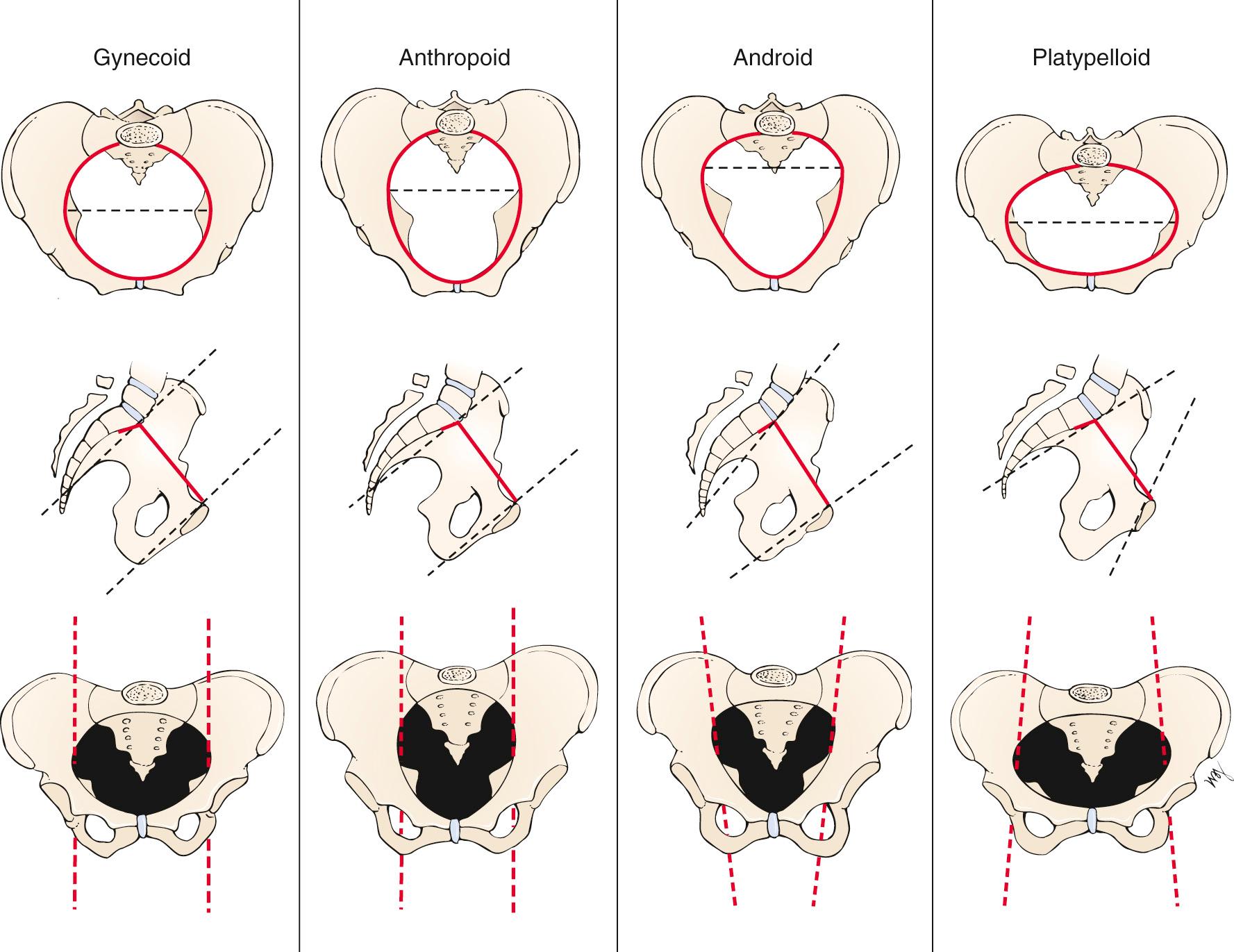 Fig. 23.6, Basic Types of Pelvic Anatomy.