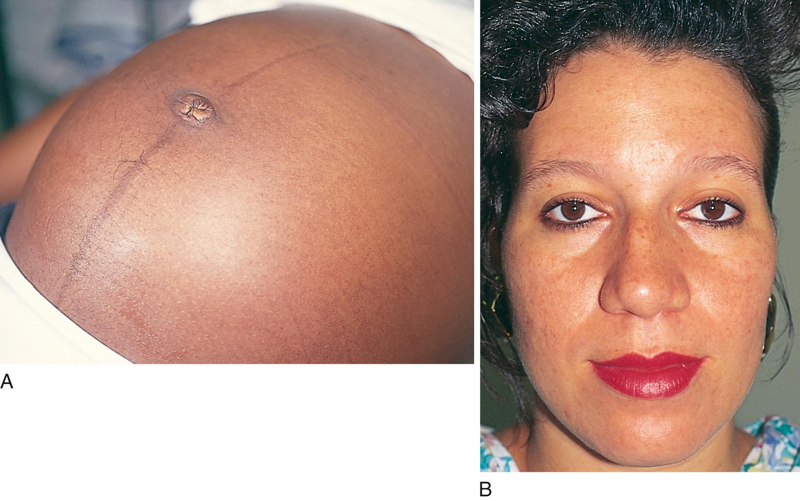 Fig. 23.8, Skin changes resulting from high levels of ovarian, placental, and pituitary hormones. (A) Linea nigra. (B) Chloasma.