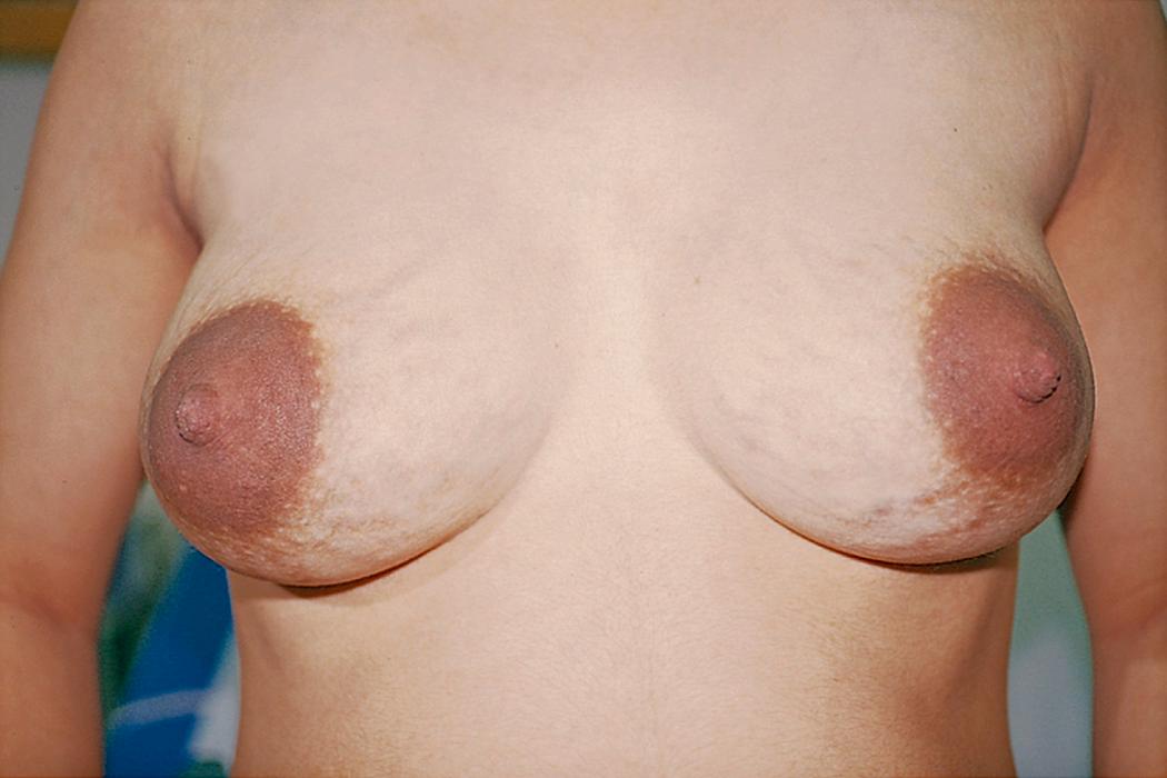 Fig. 23.10, Striae Gravidarum of the Breasts.