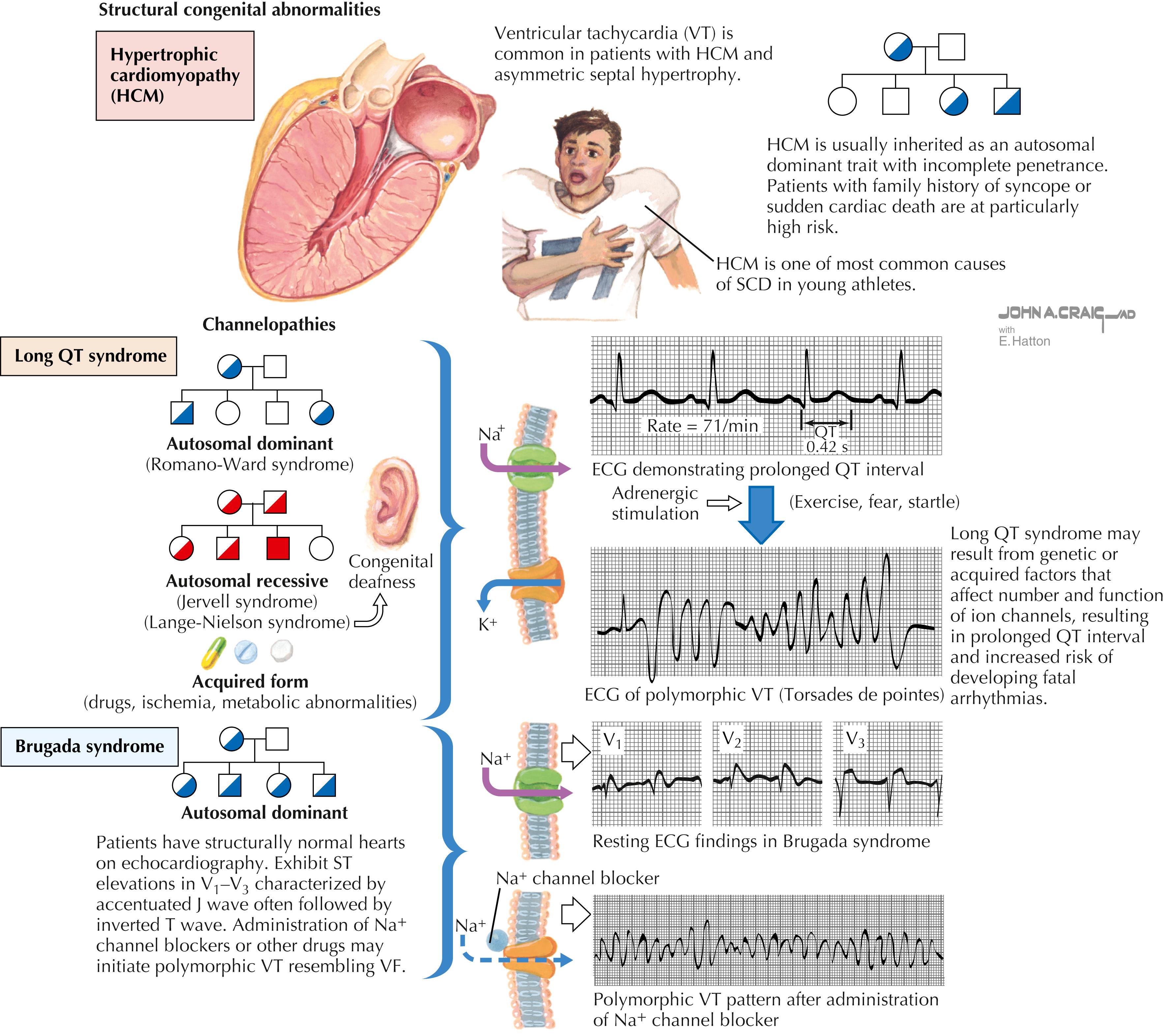 Figure 3.1, Sudden cardiac death.