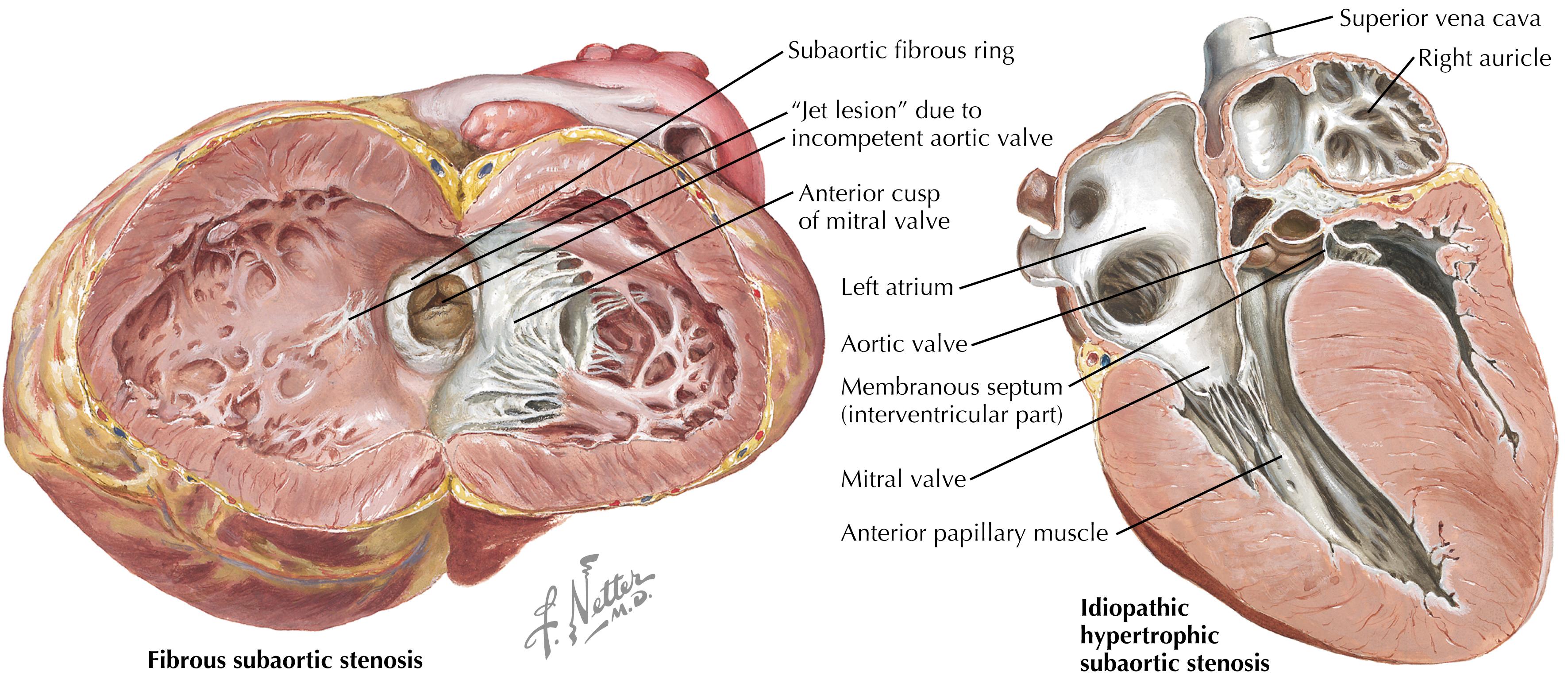 Figure 3.2, Hypertrophic cardiomyopathy.