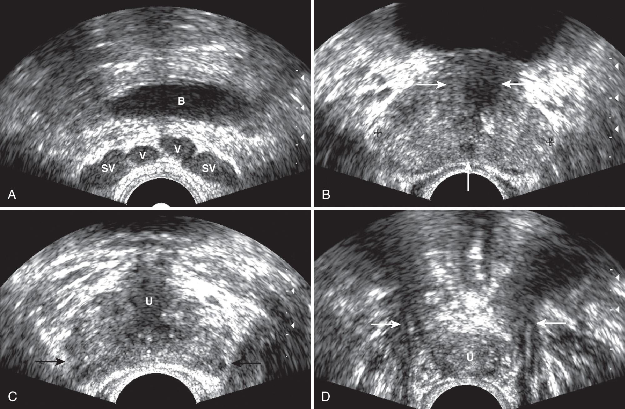 FIG. 10.2, Axial Sonograms of Prostate.