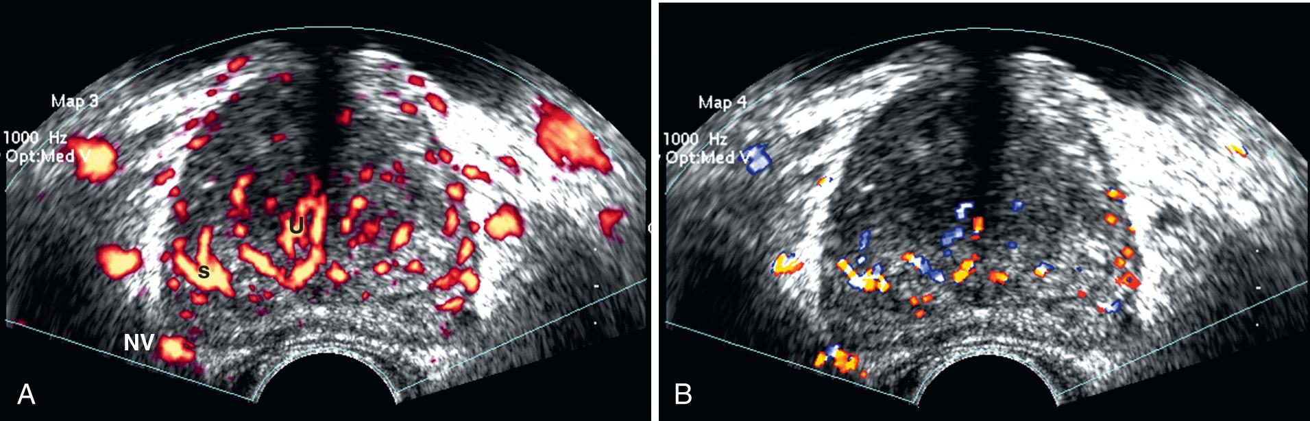 FIG. 10.5, Normal Doppler Ultrasound Anatomy in Patient With Moderate Benign Prostatic Hyperplasia (BPH).