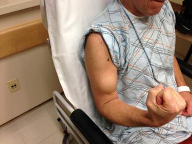 FIG. 51.1, Anterior view of a 47-year-old right-hand-dominant patient demonstrating Popeye deformity after previous LHBT tenodesis of his right arm.