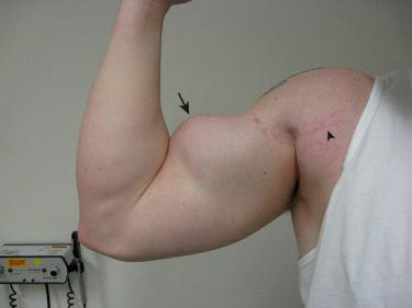 FIG. 51.2, Lateral view of a 47-year-old right-hand-dominant patient demonstrating Popeye deformity after previous LHBT tenodesis of his right arm.