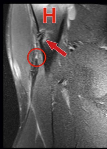 FIG. 51.3, MRI (T2, coronal view) of the right upper arm of this patient, demonstrating a failed LHBT tenodesis with an intact tenodesis screw at the humeral insertion site (indicated by red arrow) and a retracted LHBT stump (indicated by the red circle) with a gap of approximately 3 cm.