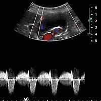 FIG. 12.11, Type 2 Endoleak.