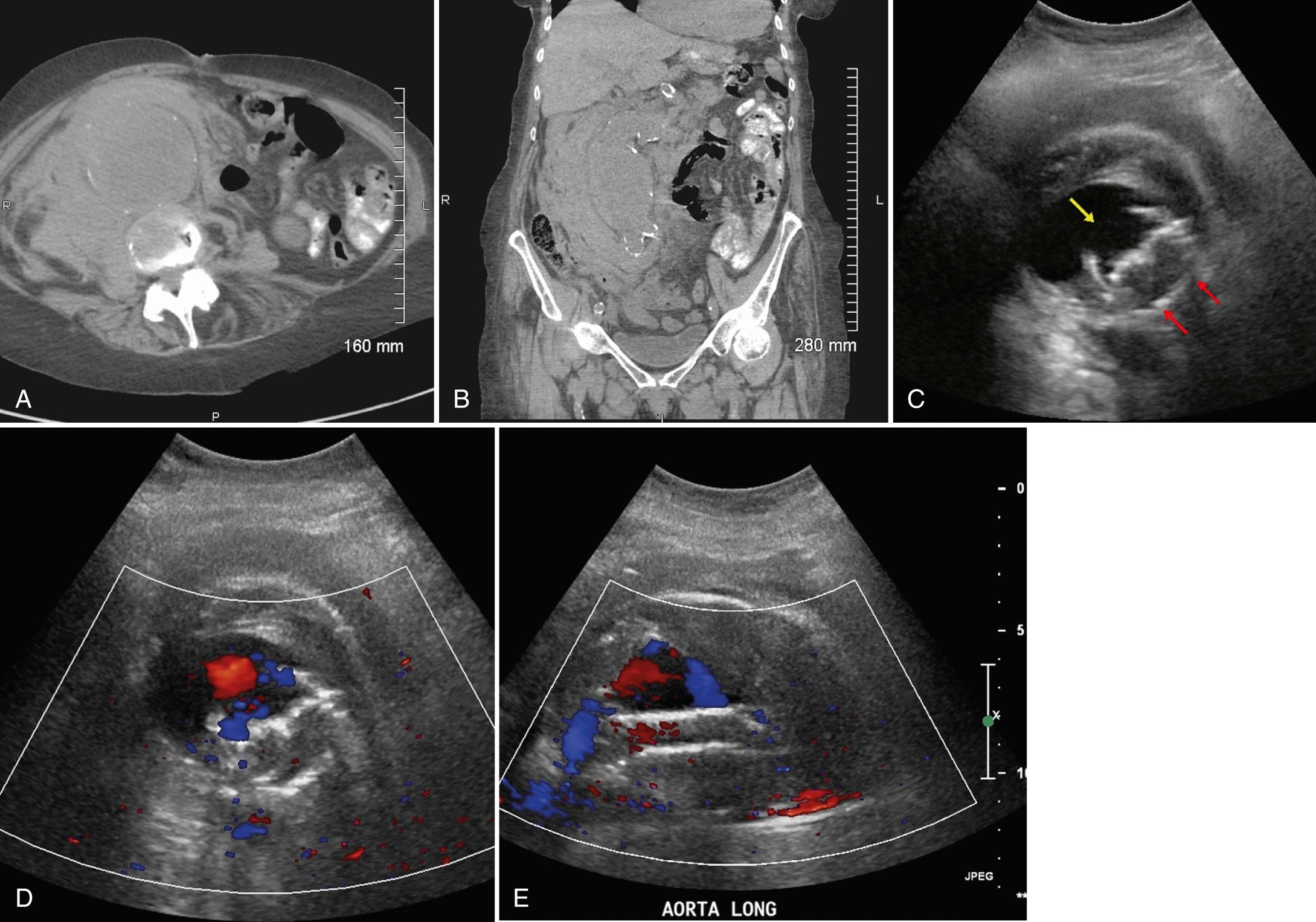 FIG. 12.12, Type 3 Endoleak.