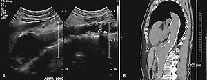 FIG. 12.2, Isolated Aneurysms of the Suprarenal Abdominal Aorta Are Rare.