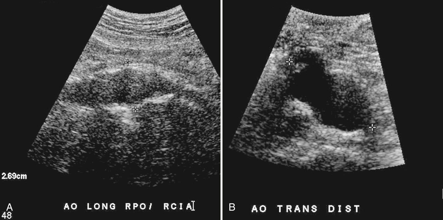 FIG. 12.5, Aorta With Saccular Aneurysm.